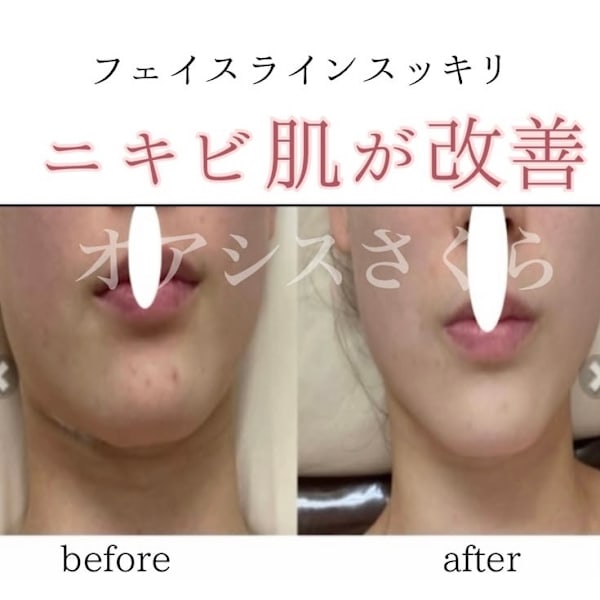 ニキビ肌・ニキビ跡も綺麗になりどんどん美しく綺麗になられます。|オアシス・さくら