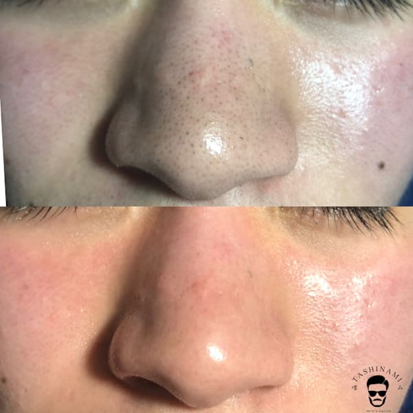 鼻の黒ずみ、イチゴ鼻、サヨナラ!!|メンズサロン 嗜み 豊橋本店