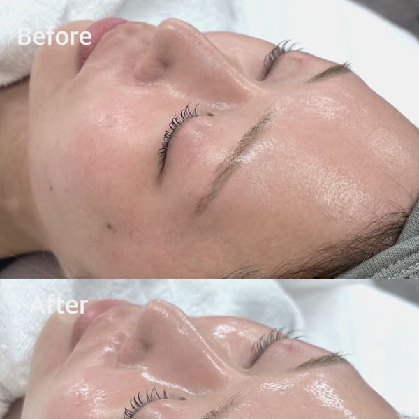 【韓国式肌管理】毛穴洗浄×ララピールで究極の肌管理★透明感溢れる水光&ツヤ肌でトーンアップが叶う♪|韓国肌管理専門店 Clear Lab 川崎【ララピール公認/毛穴洗浄/ハイドラ/ピーリング】