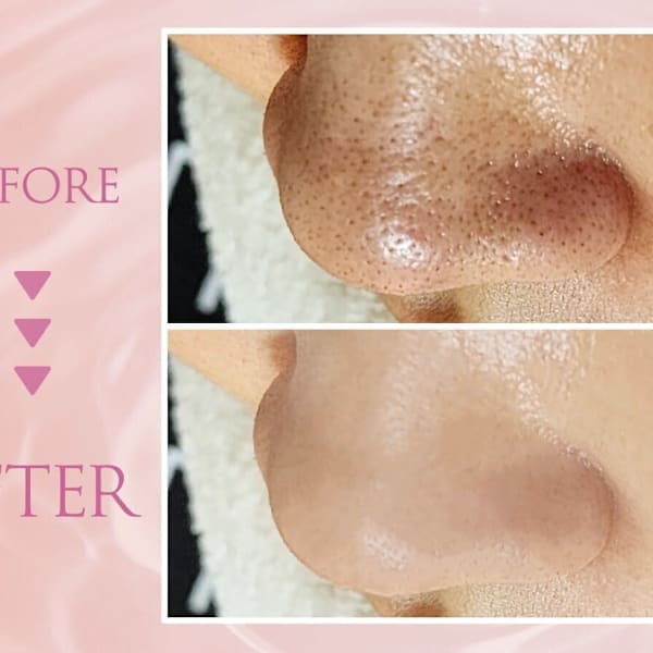 【韓国式肌管理】[韓国式毛穴洗浄&ララピール¥12000]毛穴洗浄×ララピールで毛穴の黒ずみを撲滅！|韓国肌管理専門店 Clear Lab 池袋【ララピール公認/毛穴洗浄/ピーリング】