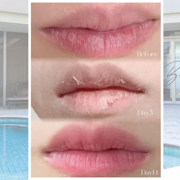 【ローマピンク大人気!】ノンケミカル美容セラム×LEDで悩める黒ずみにアプローチ!|渋谷BELZE【脱毛・毛穴洗浄・フェムケア・ローマピンク】