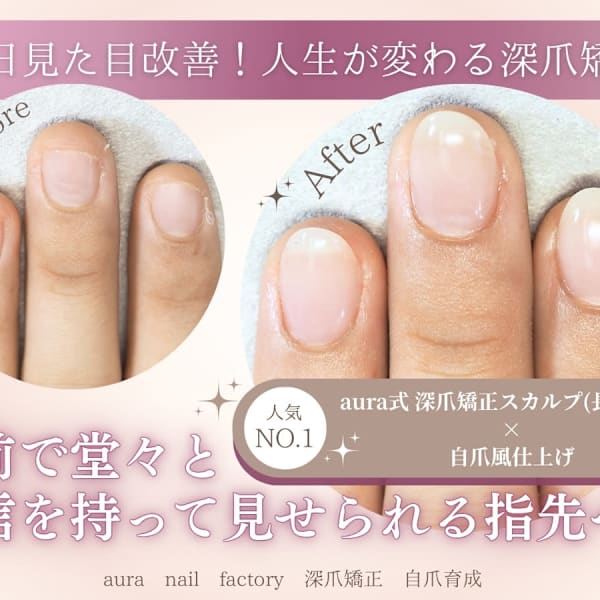 ［隠す爪から、見せたくなる爪へ］初回から見た目改善を叶える結果重視の深爪矯正スカルプ(長さだし)♪|aura nail factory