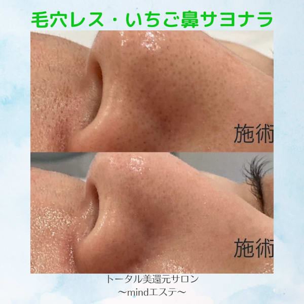 人気メニュー♪♪皮膚理論に基づいた技術『美還元フェイシャル』肌の悩みなどオールマイティに対応します☆|トータル美還元サロン mindエステ南青山店