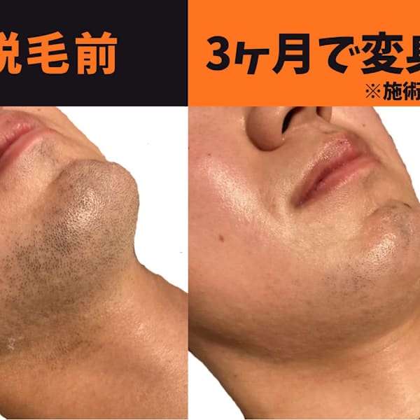 ヒゲ脱毛3ヶ月で変身|メンズ脱毛サロンmoi