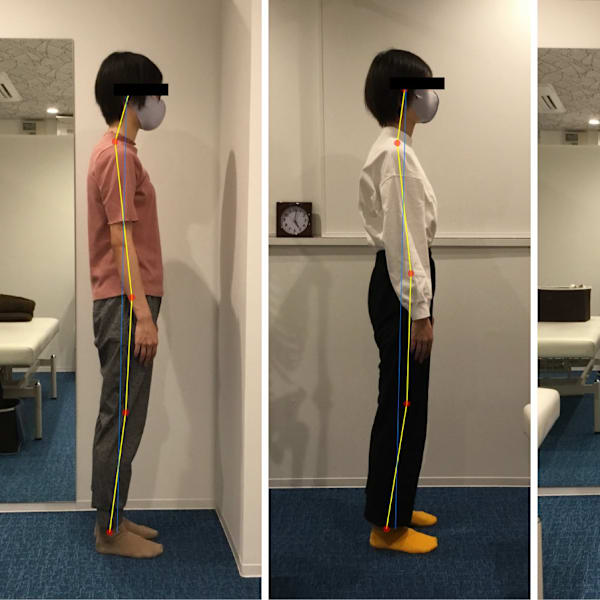 ストレートネック・反り腰を根本改善！ビフォーアフター|ミライズ整体院 三宮駅前院