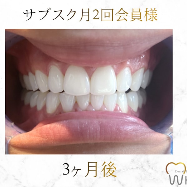 《初回限定》特別価格でご案内☆失敗しないセルフホワイトニングは新宿区の神楽坂・飯田橋エリアのホワイヤ|Whi-Ya(ホワイヤ)セルフホワイトニングDBS神楽坂