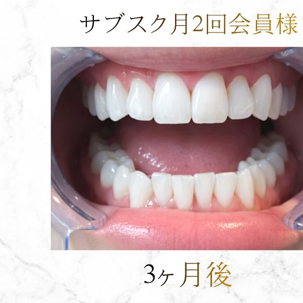 【セルフホワイトニング専門】≪透明感のある白い歯≫を実現☆都内屈指のセルフホワイトニング実力店|Whi-Ya(ホワイヤ)セルフホワイトニングDBS神楽坂