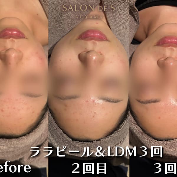 最新韓国式肌管理ララピール×LDM!毛穴レスな水光肌へ導く、痛みなしの究極の肌質改善ケア|SALON DE S AOYAMA(サロン・ド・エス アオヤマ)