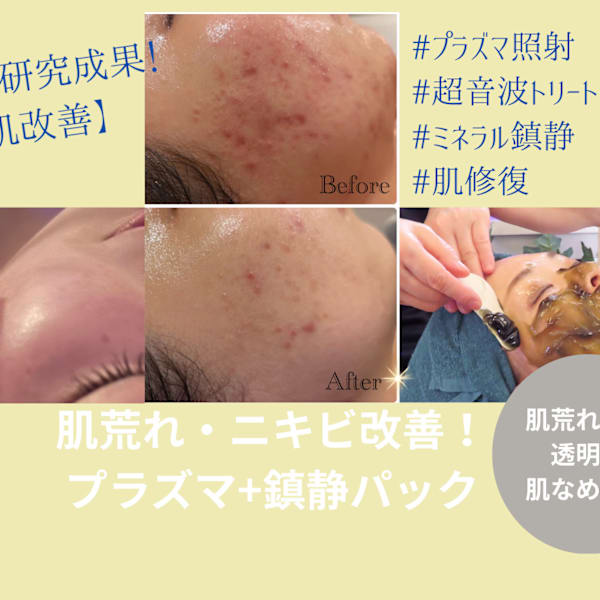 【お肌をキレイにしたい】肌荒れやニキビ、吹き出物を改善◎話題のプラズマ照射&鎮静パックで美肌改善へ|トータル美還元サロン mindエステ仙台店