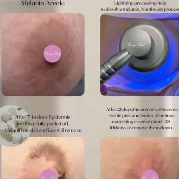 メラニン除去　乳首、VIO、脇、唇など|早く結果が出るサロン absoluteアブソリュート
