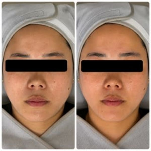 オーダーメイドフェイシャル¥13.200→¥7.990-( Custom-made facial)|SALON DE JEWEL