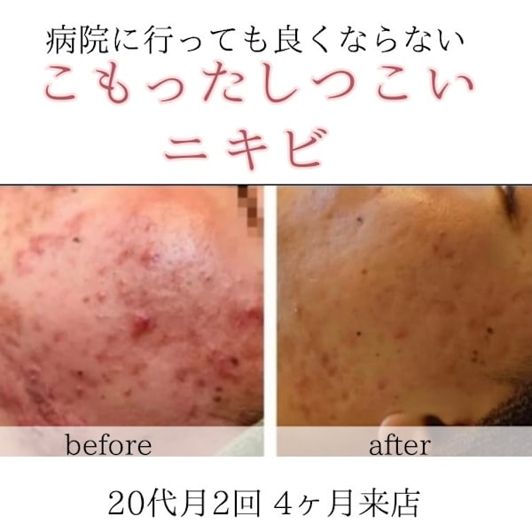 ニキビ・ニキビ跡は毛穴を綺麗に摩擦を与えない|オアシス・さくら