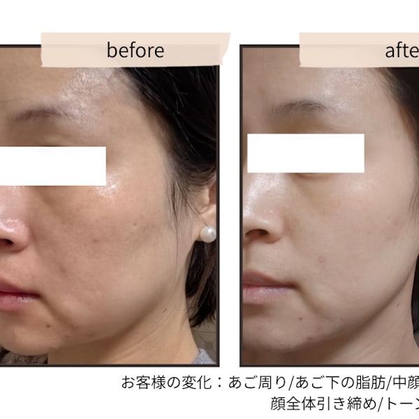 たるみケアを色々試したけど満足できなかった方へ|convince beauty esthetic