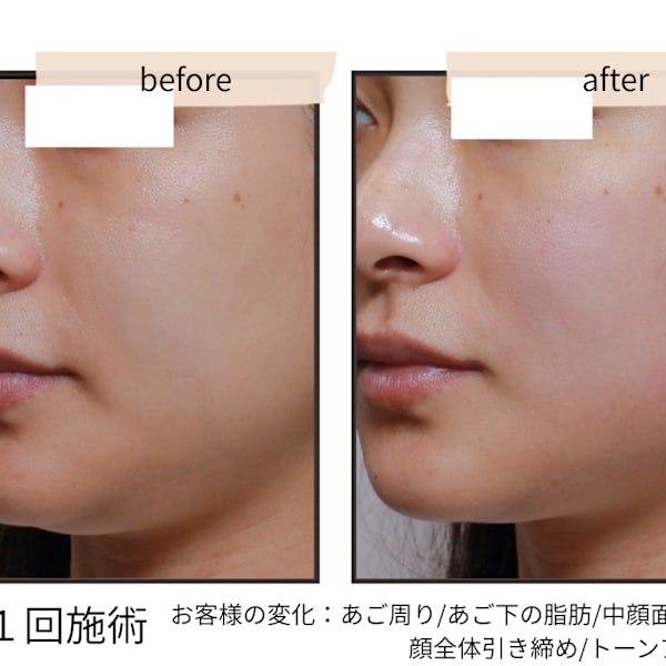 痩せても消えない二重あごの原因とは？|convince beauty esthetic
