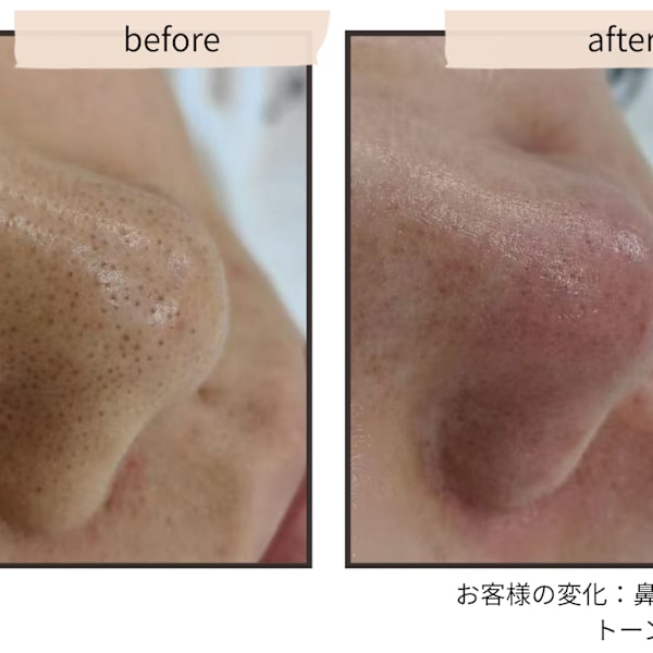 毛穴洗浄やハーブピーリングで満足できなかった方へ|convince beauty esthetic