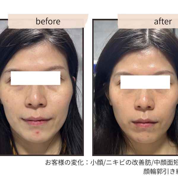 結婚式まであと少し。後悔しない花嫁ケアを。|convince beauty esthetic