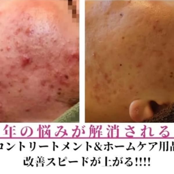 ニキビが出来にくくなり肌が輝きます|オアシス・さくら