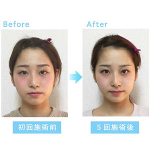 エラ張り 歪み むくみ 小顔 リフトアップ 筋肉に特化した高リピート率の回数チケット 本場韓国式 小顔コルギ L O V I T ホンバカンコクシキ コガオコルギ ラヴィット のこだわり特集 リラク マッサージサロンを予約するなら楽天ビューティ エラ張り 歪み むくみ 小顔 リフトアップ 筋肉に特化した高リピート率の回数チケット 本場韓国式 小顔コルギ L O V I T ホンバカンコクシキ コガオコルギ ラヴィット のこだわり特集 リラク マッサージサロンを予約するなら楽天ビューティ