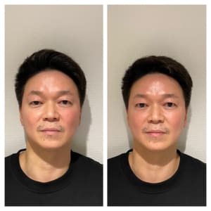 当日予約歓迎》おすすめ♪【フォーカスネオ】二重アゴ、シワ
