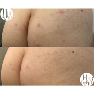 ハーブピーリング専門店 HERBERRY(ハーブピーリングセンモンテン