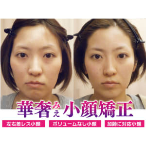 HEADRANG 小顔Vライン顔左右非対称矯正 HEADRANG W ヘッドラング 韓国小顔矯正の通販 by kiii's｜ラクマ