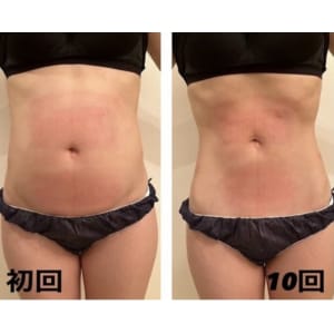 12℃脂肪冷却×世界初！次世代EMS寝てるだけで約2万回の腹筋効果