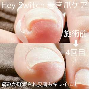 日本初！ジェルで巻き爪ケア！ | Ethical B. Tokyo(エシカルビー