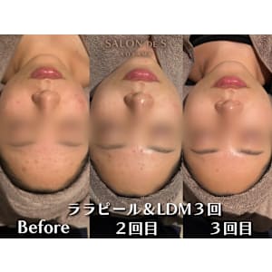 最新韓国式肌管理ララピール×LDM！毛穴レスな水光肌へ導く、痛みなしの