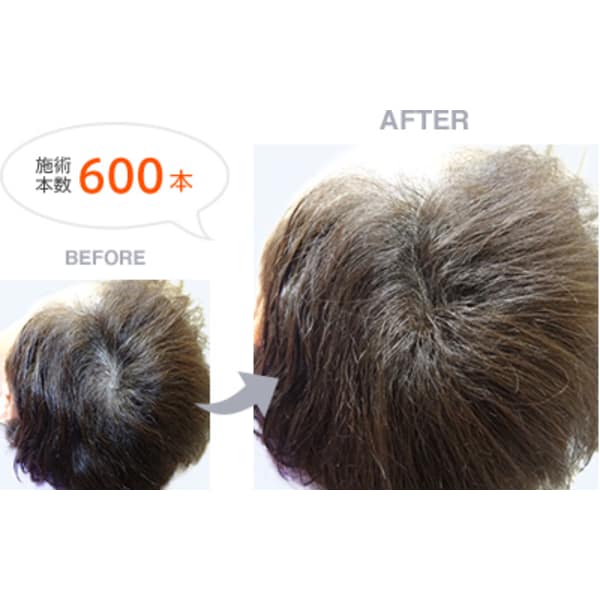 人気メニュー！　ボリュームアップ増毛６００本