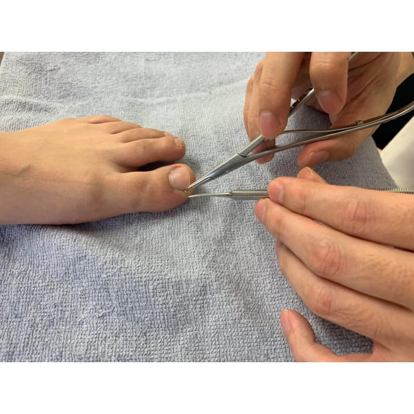 巻き爪矯正コース