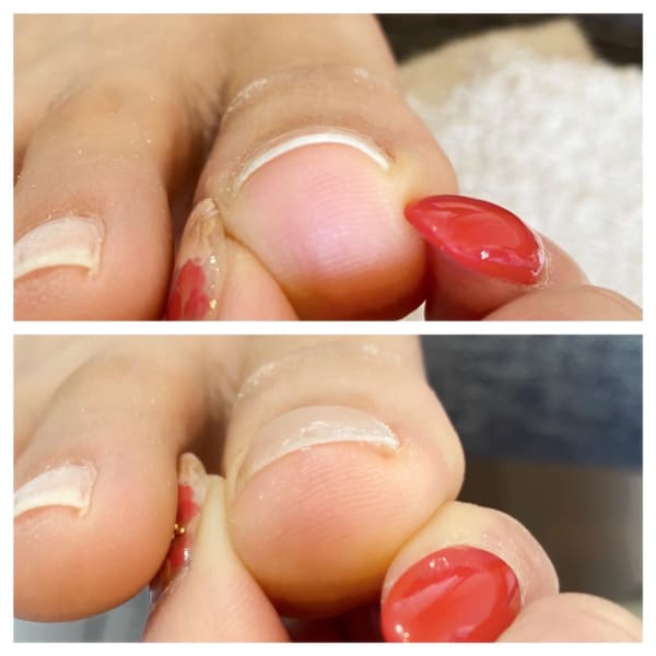 【初回限定】巻爪矯正ケアポリッシュペディキュアカラーセットで★￥8800！