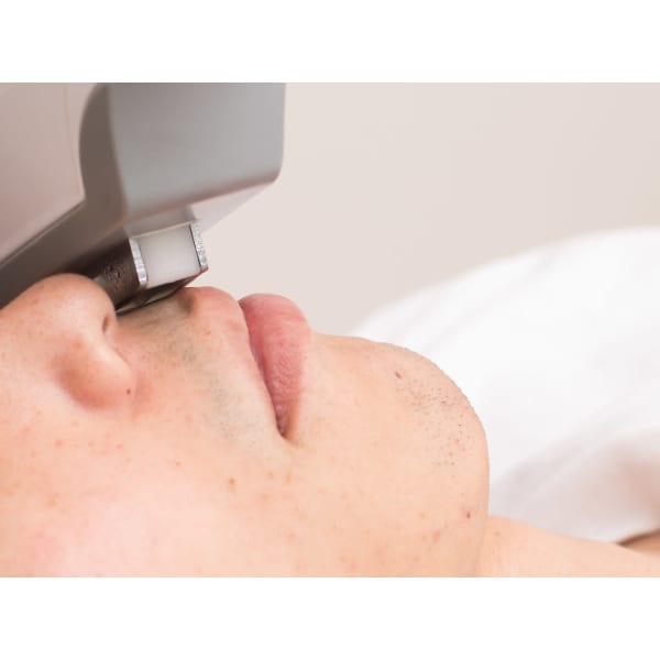 【ヒゲ脱毛】1回3300円