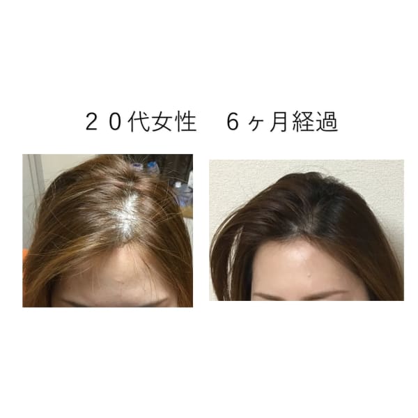 《女性育毛》初回体験クーポン　