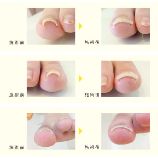 【巻いた爪補正】初回カウンセリング無料