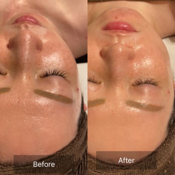 毛穴、くすみ、シワ改善!美肌再生バクテリウムピールトリートメント