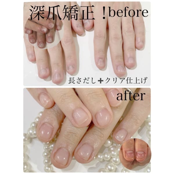 どんな深爪さんでもお任せください♪【深爪矯正・自爪育成】ツヤ仕上げ