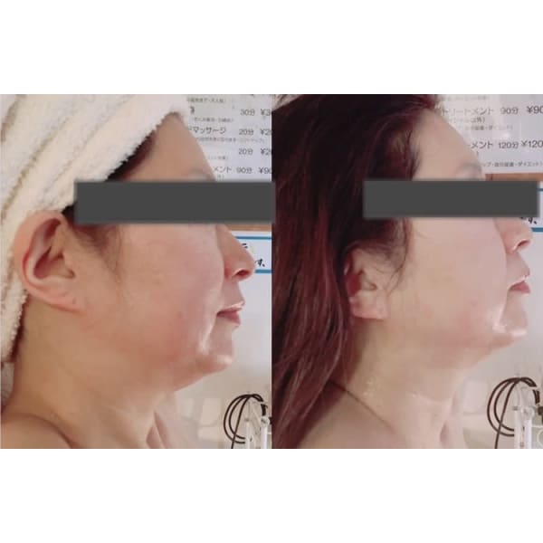 顔むくみスッキリコース