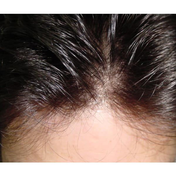 頭皮カウンセリングカット