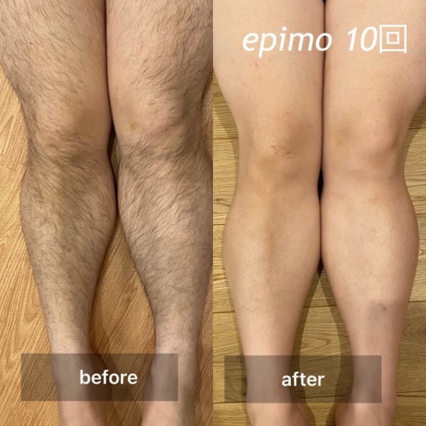 初回限定3,500円お試し　顔(ヒゲ)・ひざ上・ひざ下・ひじ上・ひじ下・ワキ・うなじ各3,500円