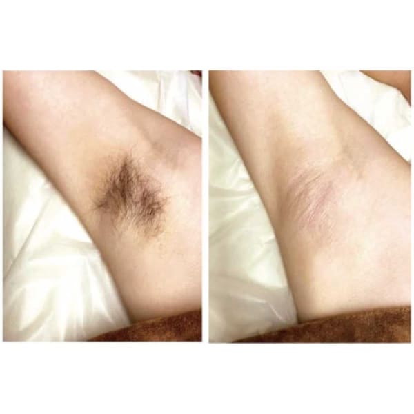 【レディース】ワキ脱毛