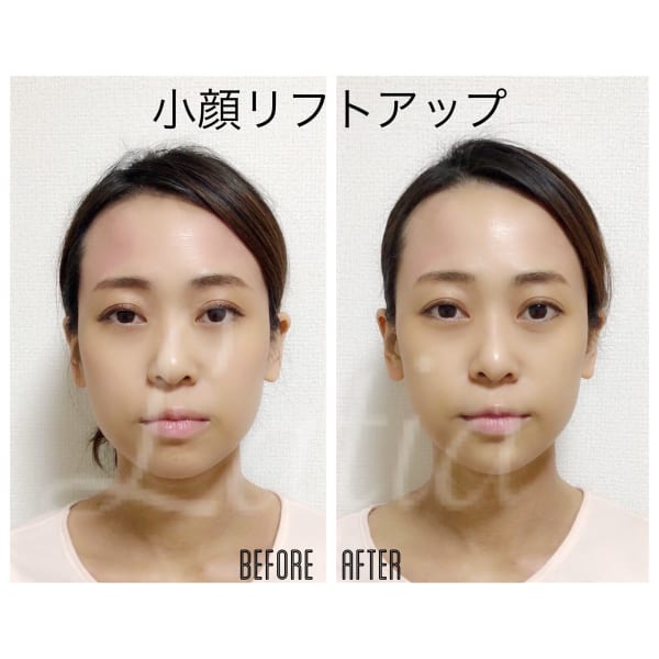 【小顔整顔SET】うるすべつるん♪敏感肌も♪本格ブライダルシェービング3時間／回数：1回