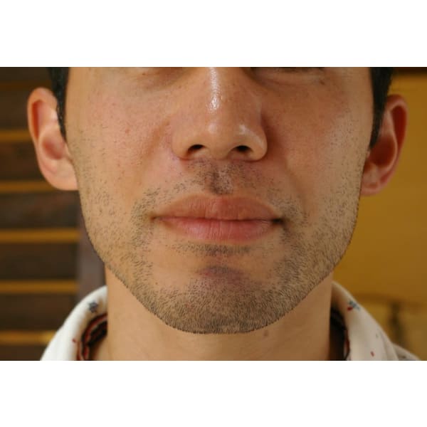 男性脱毛一ヵ所(額・ほほ・鼻下・あご・あご下・首回り・手の甲指・乳輪周り・足の甲指から選ぶ）