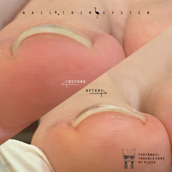 【巻爪モニター募集】１回目から痛みの軽減を実感！安心の３回セット通常価格￥22000～⇒￥11000