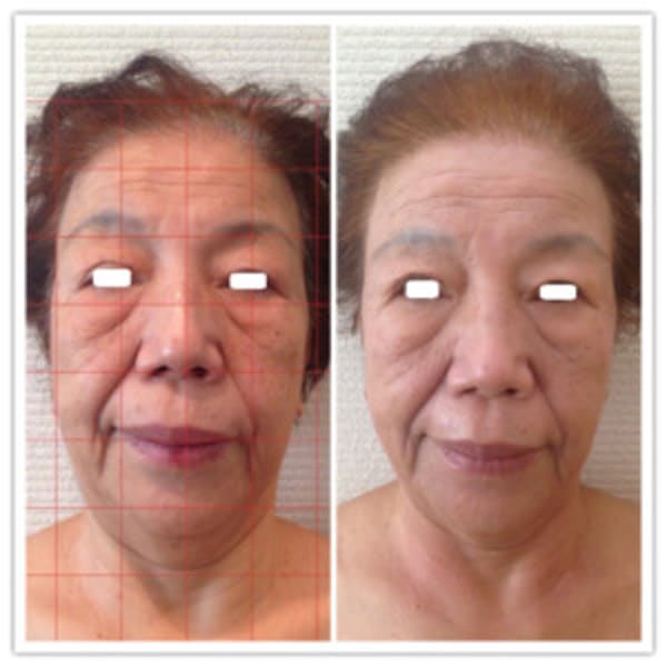 世界特許エンダモロジーと『コルギ』の技で小顔矯正