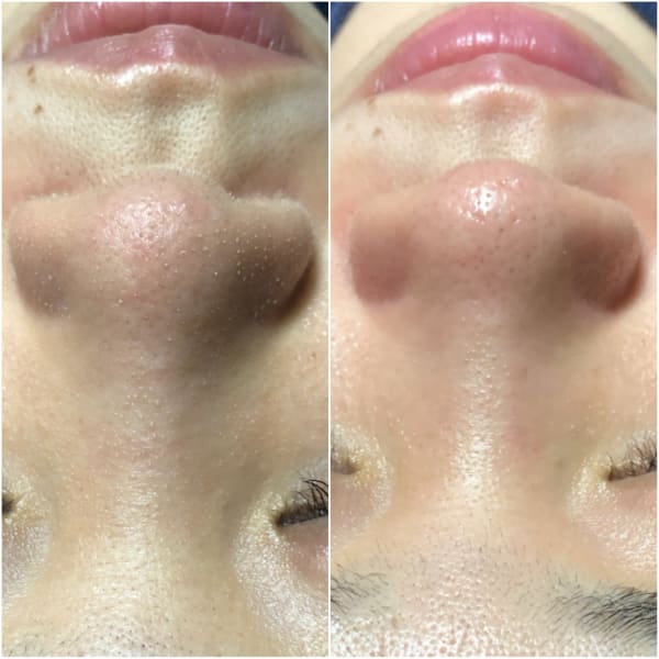 3種の美容液使用で究極毛穴ケア【毛穴洗浄+美容液導入】(90分)※お試し9000円→6900円