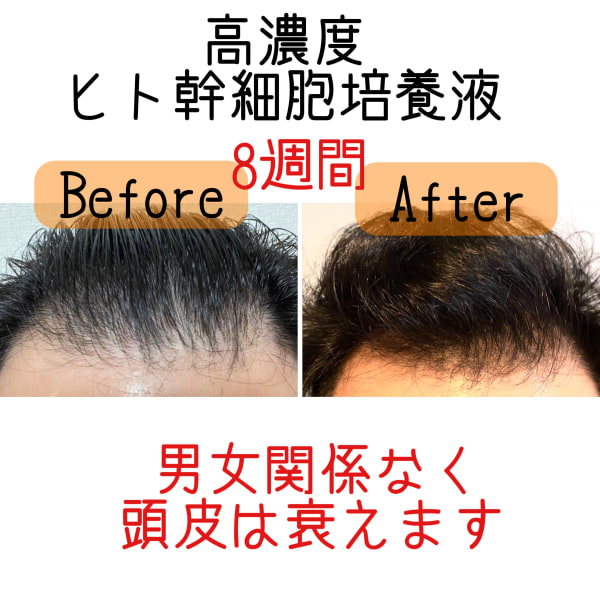 強髪プログラム【ボリューム、抜け毛、触角、伸びない毛】に悩んだら¥3850～