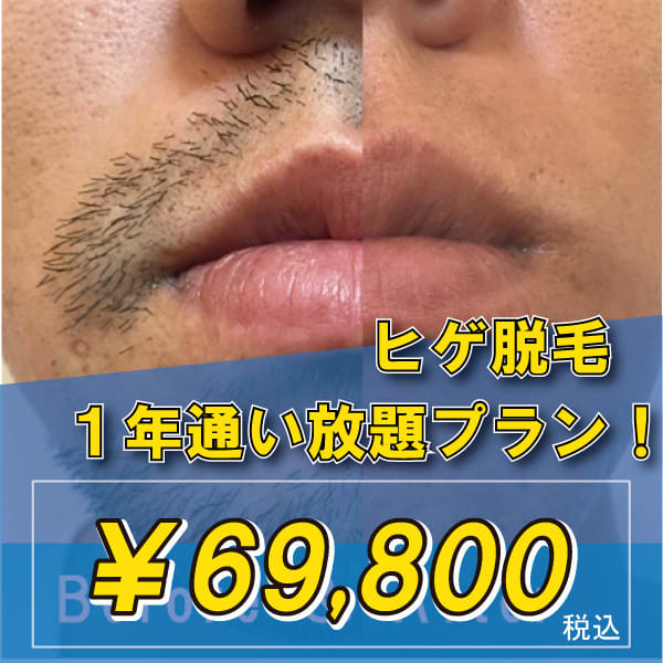 ヒゲ脱毛1年通い放題プラン【最高来店回数24回】