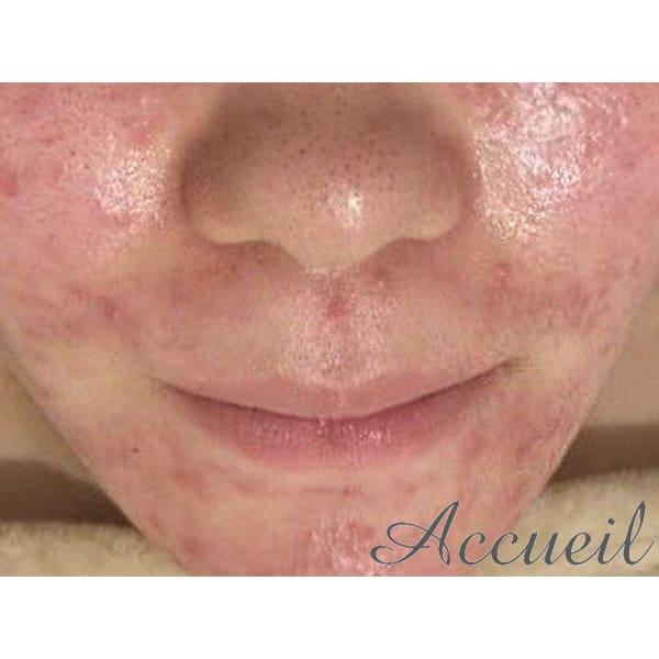 【当店人気No.1★】とにかく迷ったらこれ！！肌トラブル総合改善コース