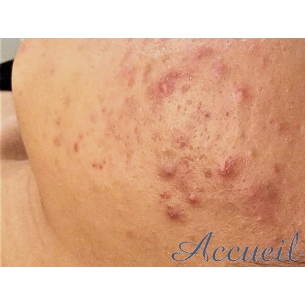 【平日限定】1名様★ニキビケアがいつもより−￥500お得★