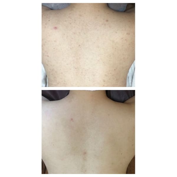 【Exuviance】背中美人ピールトリートメント